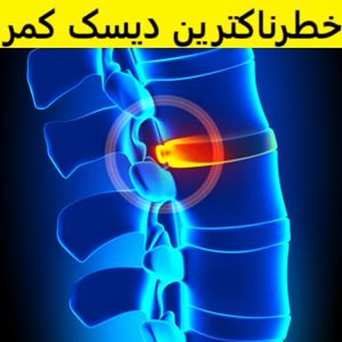 خطرناک ترین دیسک کمر (علائم اورژانسی + درمان قطعی دیسک کمر 2024)