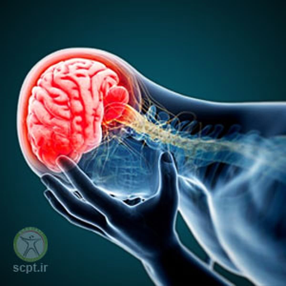 سردردهای میگرنی و شبه میگرنی