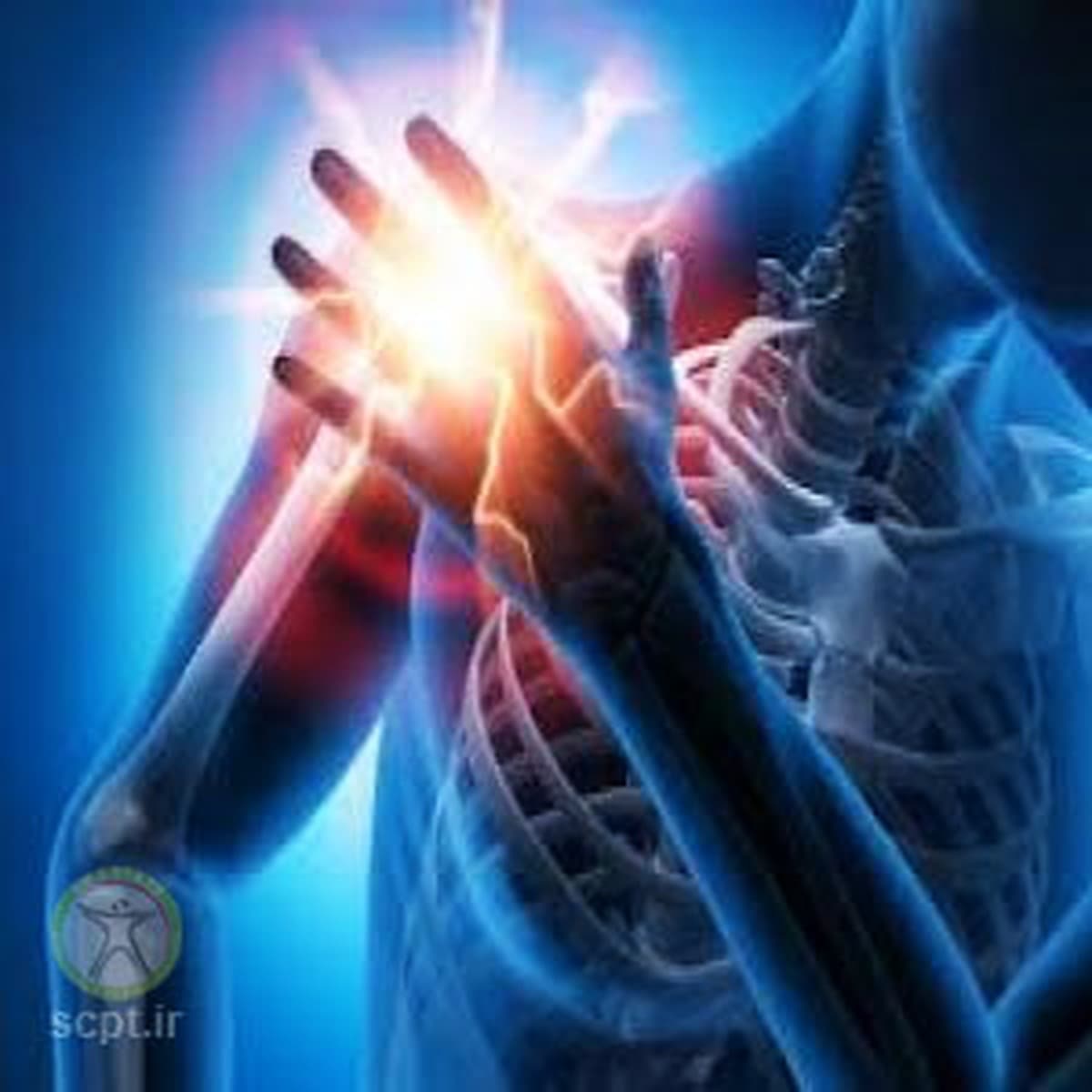 شانه یخزده (Frozen Shoulder)