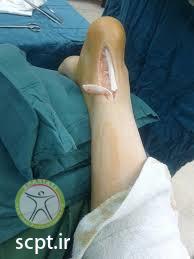 http://scpt.ir/uploads/Achilles-Tendon-rupture-4-surgery.jpg