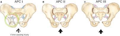 pelvic injury physiotherapy shariati http://scpt.ir/uploads/Anterior posterior compression fracture pelvis.jpg