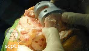 http://scpt.ir/uploads/Arthroplasty surgery.jpg