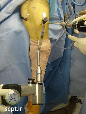 http://scpt.ir/uploads/Drilling-of-the-tibial-tunnel.png