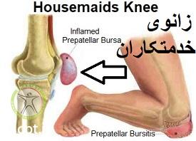 http://scpt.ir/uploads/Housemaids-knee-prepatellar-bursitis.jpg