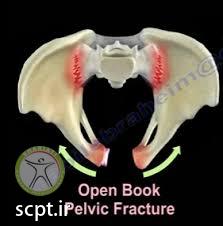 http://scpt.ir/uploads/Open-book pelvic injury.jpg