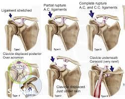acromioclavicular joint stage shariati