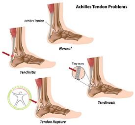 http://scpt.ir/uploads/achilles-tendon-injuries-different.jpg