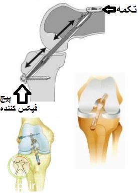 http://scpt.ir/uploads/acl-reconstruction-surgery-graft-fixation.jpg