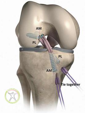 http://scpt.ir/uploads/acl-reconstruction-surgery-steps-antromedial-postrolateral.png