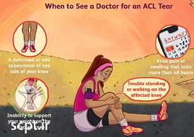 http://scpt.ir/uploads/acl-signs-and-symptoms.png