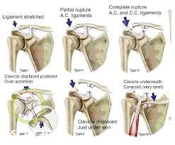 ac joint injury stage