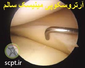 http://scpt.ir/uploads/arthroscopy-normal-meniscus.jpg