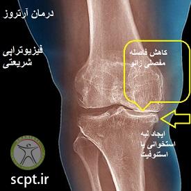 http://scpt.ir/uploads/arthrosis-knee-osteophyte.jpg