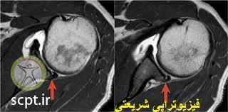 http://scpt.ir/uploads/bankart lesion MRI.jpg