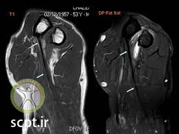 http://scpt.ir/uploads/biceps brachii tear distal MRI.jpg