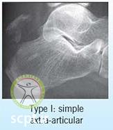 http://scpt.ir/uploads/calcaneus types of fractures-1.jpg