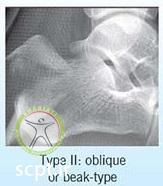 http://scpt.ir/uploads/calcaneus types of fractures-2.jpg