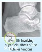 http://scpt.ir/uploads/calcaneus types of fractures-3.jpg