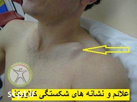 http://scpt.ir/uploads/clavicle-fracture-signs.jpg