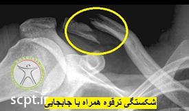http://scpt.ir/uploads/clavicle-fracture.jpg
