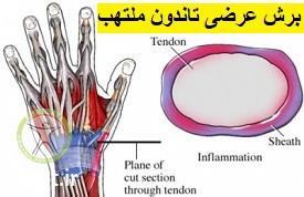 http://scpt.ir/uploads/de-duervain-inflamation-tendon.jpg