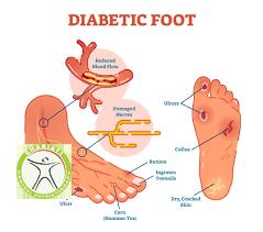 http://scpt.ir/uploads/diabetic foot laser therapy vascular.png