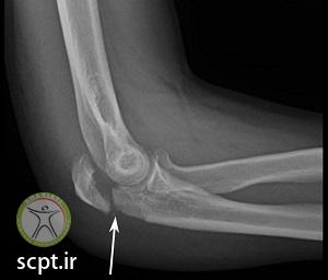 http://scpt.ir/uploads/elbow fracture radiology X ray.jpg