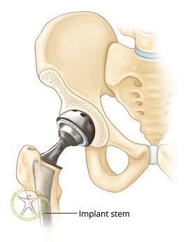 http://scpt.ir/uploads/femoral-head-fracture_hip-prosthesis.jpg