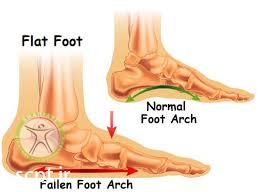 http://scpt.ir/uploads/flat foot pain.jpg