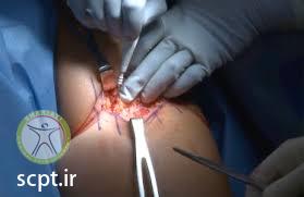 http://scpt.ir/uploads/hamstring tear proximal surgery.jpg