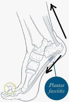 http://scpt.ir/uploads/heel-pain-walking-biomechanics.jpg
