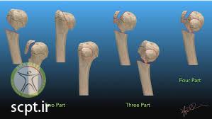 type of humeral head fracture