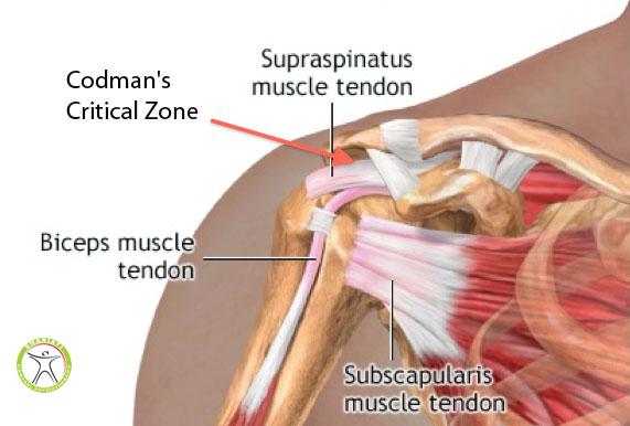 Supraspinatus tendonitis