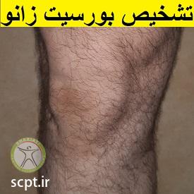 http://scpt.ir/uploads/knee-bursitis-diagnosis.jpg