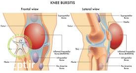 http://scpt.ir/uploads/knee-bursitis.jpg
