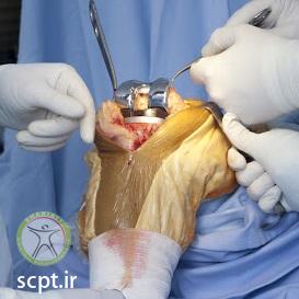http://scpt.ir/uploads/knee-joint-replacement-surgery.jpg