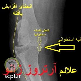 http://scpt.ir/uploads/knee-osteoarthritis-DJD-radiology-X-ray-1.jpg