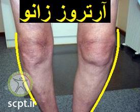http://scpt.ir/uploads/knee-osteoarthritis-DJD.jpg