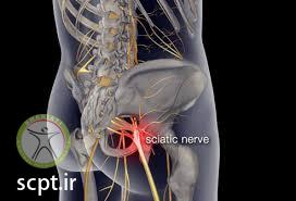 http://scpt.ir/uploads/low back pain sciatic nerve.jpg