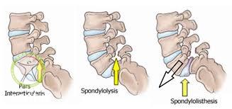 http://scpt.ir/uploads/low back pain spondylolysis & spondylolisthesis.jpg