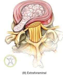 http://scpt.ir/uploads/low-back-pain-lumbar-disc-herniation-classification-extraforaminal.jpg