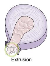 http://scpt.ir/uploads/low-back-pain-lumbar-disc-herniation-classification-extrusion.jpg