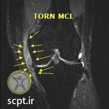 http://scpt.ir/uploads/mcl tear injury diagnosis MRI.jpg