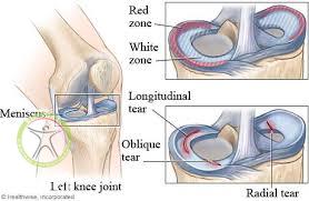 http://scpt.ir/uploads/meniscus tear type.jpg