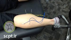 http://scpt.ir/uploads/muscle spam cramp leg treatment needling.jpg