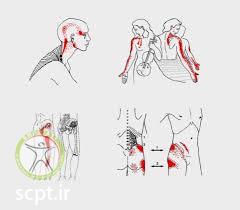 http://scpt.ir/uploads/myofascial pain syndrome pain pattern.jpg