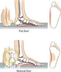 http://scpt.ir/uploads/normal feet versus flat feet.jpg