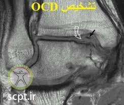 http://scpt.ir/uploads/osteochondritis-dissecans-ankle-diagnosis-1.jpg
