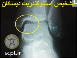 http://scpt.ir/uploads/osteochondritis-dissecans-ankle-diagnosis.jpg