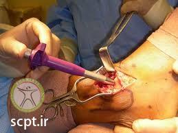 http://scpt.ir/uploads/osteochondritis-dissecans-ankle-surgery.jpg